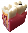 Купить paro® Демонстраційна модель карієсу зубів